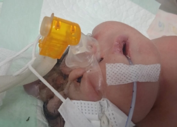 Butuh Bantuan Dermawan, Bayi Perempuan di Palembang Tidak Ada Tempurung Kepala